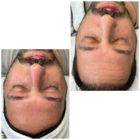 One MicroInfusion Treatment by EP Micropen Provider Karla.